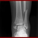 fracture